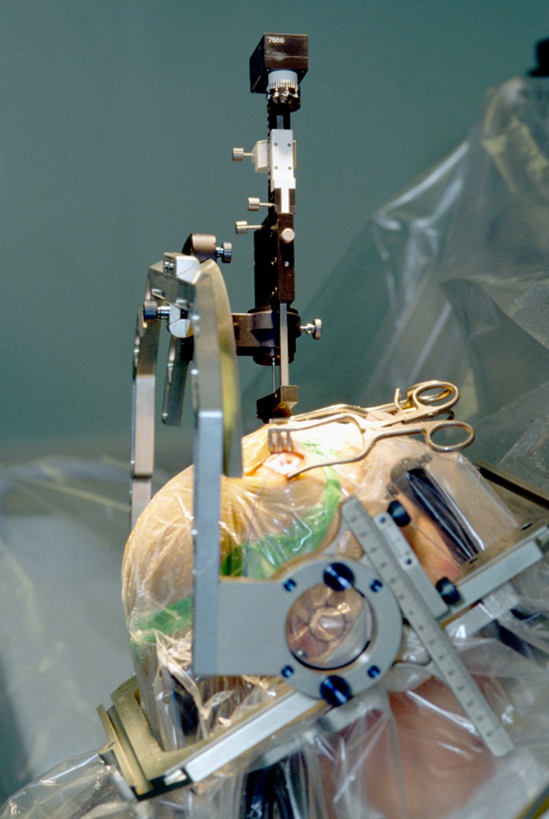 Advanced Neurosurgical Techniques